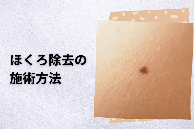 東京美容外科、ほくろ除去の施術方法